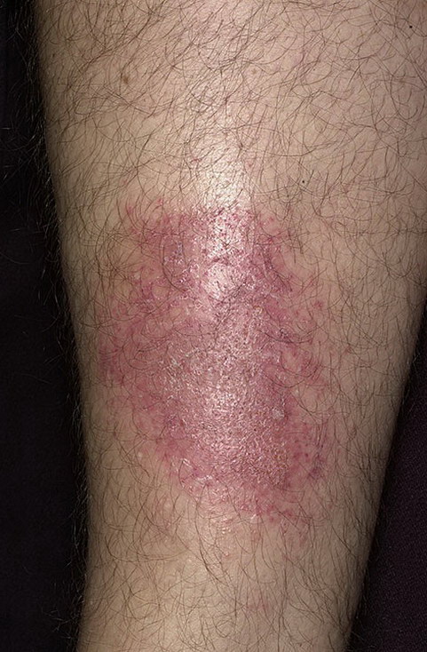признаки дерматита на ногах