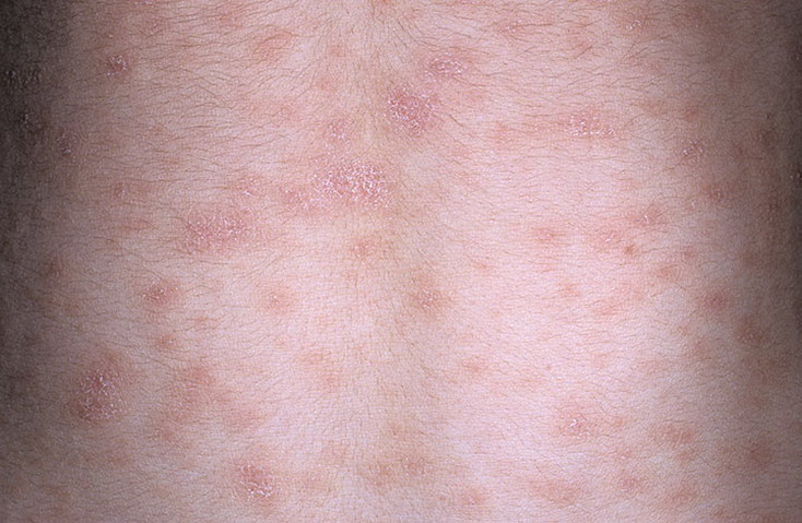 Как выглядит лишай розовый Жибера фото – 181 шт. / nezdorov.com