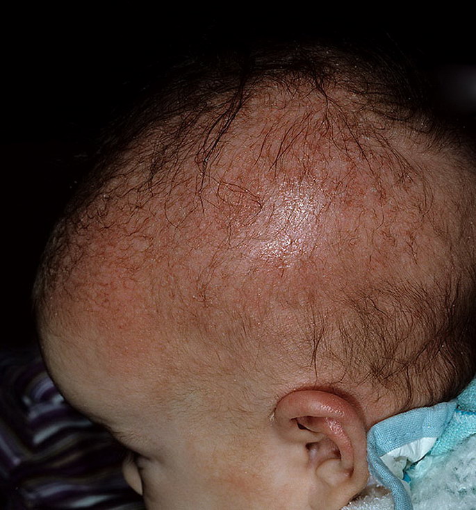 Как выглядит болезнь себорея фото – 287 шт. / nezdorov.com