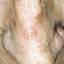 1. Рак кожи на носу фото