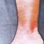 2. Рожистое воспаление на ноге фото