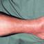 4. Рожистое воспаление на ноге фото