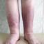 7. Рожистое воспаление на ноге фото