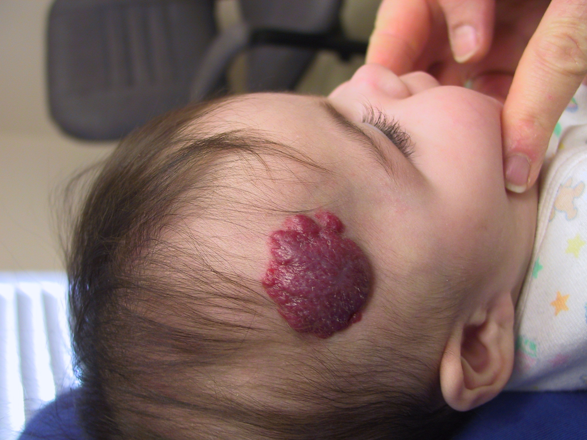 Hemangioma head