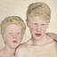 10. Альбинизм фото