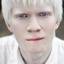 20. Альбинизм фото