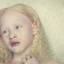 24. Альбинизм фото