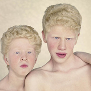 Альбинизм у людей