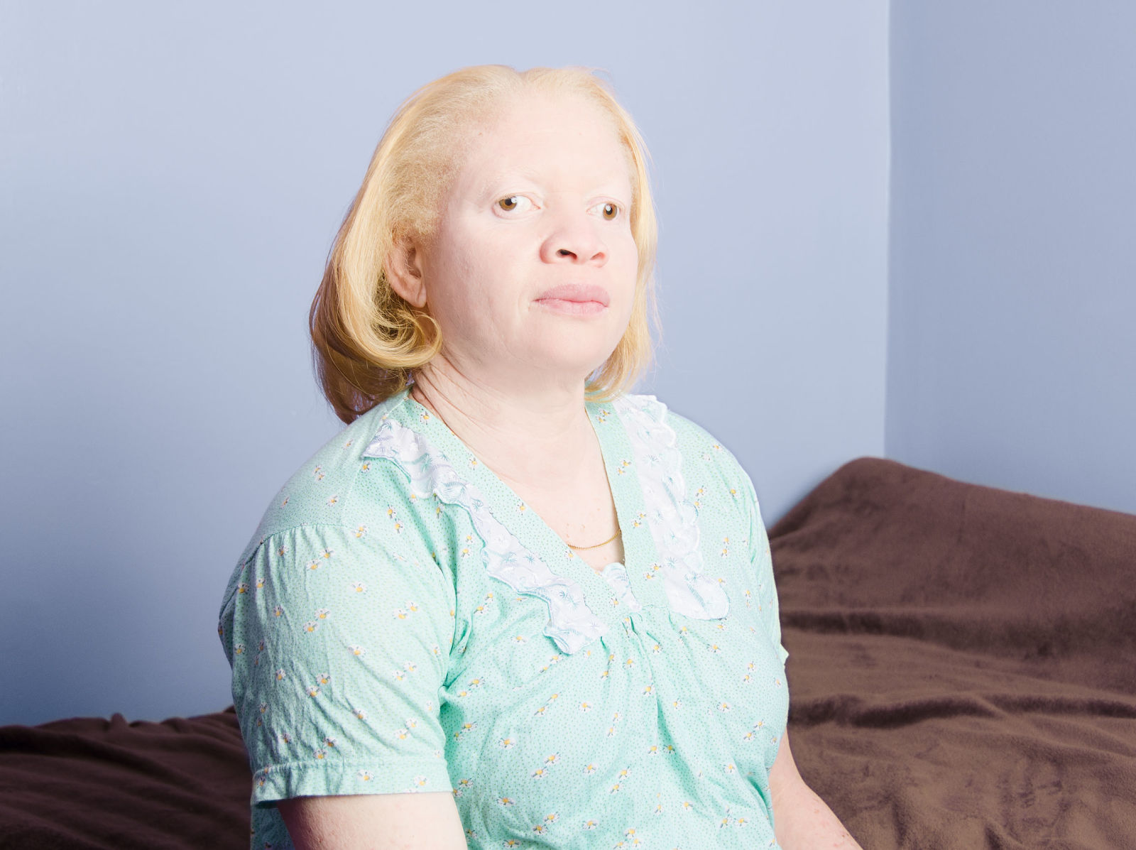Как люди рождаются альбиносами. Фенилкетонурия и альбинизм. Лазно-кожный альбинизм.