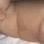 1. Нейрофиброматоз у новорожденных фото