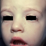 Контагиозный моллюск у детей на лице