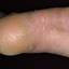 2. Гиперкератоз кожи ног фото