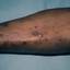 9. Гиперкератоз кожи ног фото