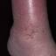 10. Застойный дерматит на ногах фото
