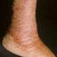 102. Застойный дерматит на ногах фото