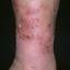 103. Застойный дерматит на ногах фото