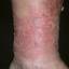 105. Застойный дерматит на ногах фото