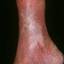 107. Застойный дерматит на ногах фото