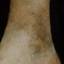 108. Застойный дерматит на ногах фото