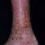 109. Застойный дерматит на ногах фото