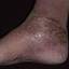 11. Застойный дерматит на ногах фото