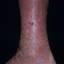 110. Застойный дерматит на ногах фото