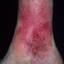 111. Застойный дерматит на ногах фото