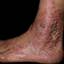 112. Застойный дерматит на ногах фото