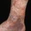 114. Застойный дерматит на ногах фото