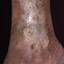 115. Застойный дерматит на ногах фото