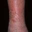 117. Застойный дерматит на ногах фото