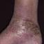 12. Застойный дерматит на ногах фото