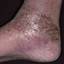 13. Застойный дерматит на ногах фото