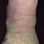 131. Застойный дерматит на ногах фото