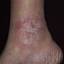 139. Застойный дерматит на ногах фото