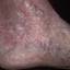 14. Застойный дерматит на ногах фото