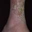 147. Застойный дерматит на ногах фото
