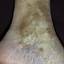 15. Застойный дерматит на ногах фото
