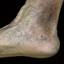 157. Застойный дерматит на ногах фото