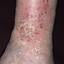 159. Застойный дерматит на ногах фото