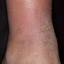 162. Застойный дерматит на ногах фото