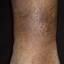 17. Застойный дерматит на ногах фото