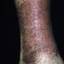 173. Застойный дерматит на ногах фото