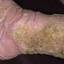 174. Застойный дерматит на ногах фото