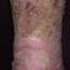 2. Застойный дерматит на ногах фото
