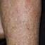 20. Застойный дерматит на ногах фото