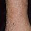 21. Застойный дерматит на ногах фото