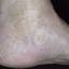 22. Застойный дерматит на ногах фото