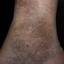25. Застойный дерматит на ногах фото