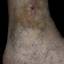 26. Застойный дерматит на ногах фото